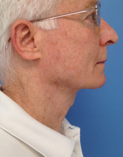 Direct Excision Neck Lift