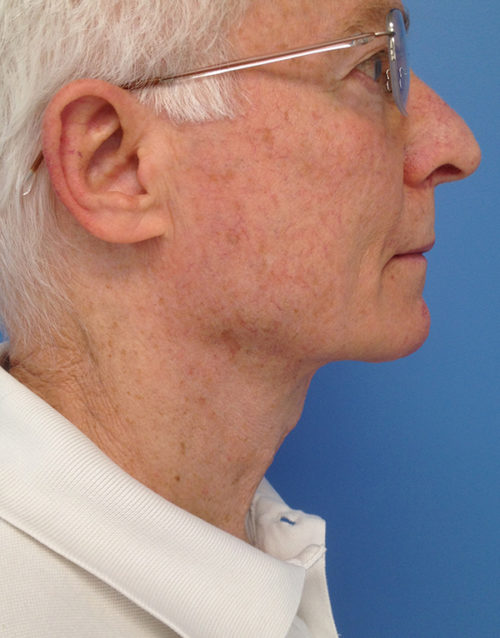 Direct Excision Neck Lift Case 1158 After Photo Direct Excision Neck Lift