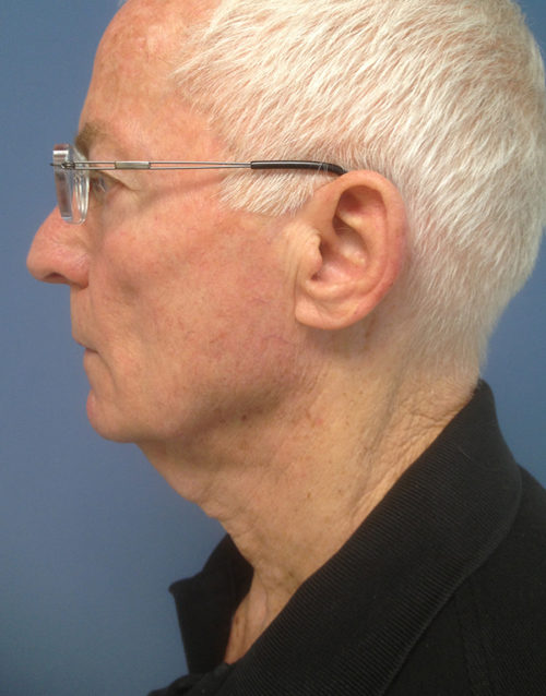 Direct Excision Neck Lift Case 1158 Before Photo Direct Excision Neck Lift