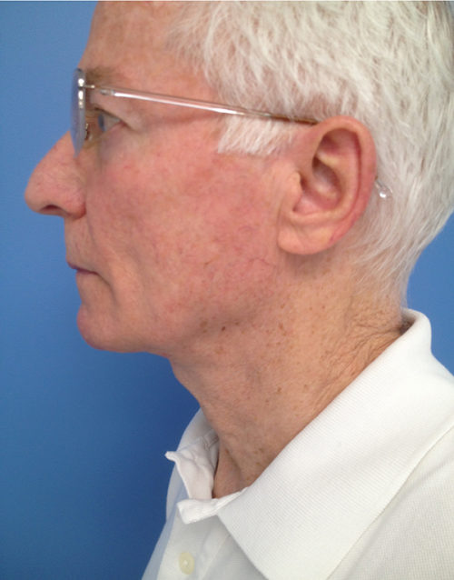 Direct Excision Neck Lift Case 1158 After Photo Direct Excision Neck Lift