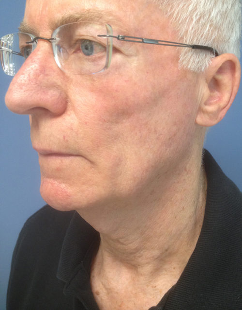 Direct Excision Neck Lift Case 1158 Before Photo Direct Excision Neck Lift