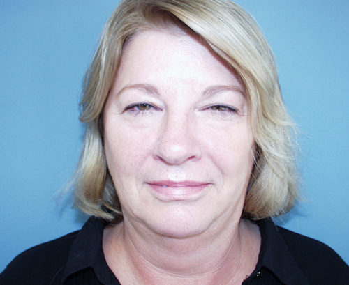 Eyelid Surgery Case 1172 Before Photo Eyelid Surgery