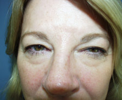 Eyelid Surgery