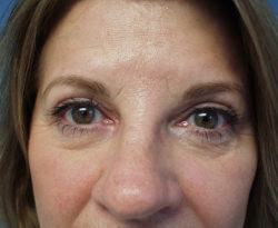 Eyelid Surgery