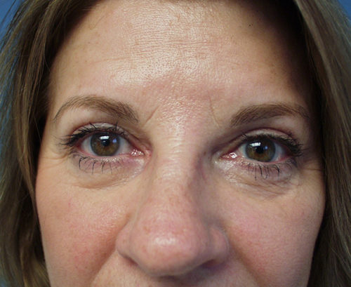 Eyelid Surgery Case 1172 After Photo Eyelid Surgery