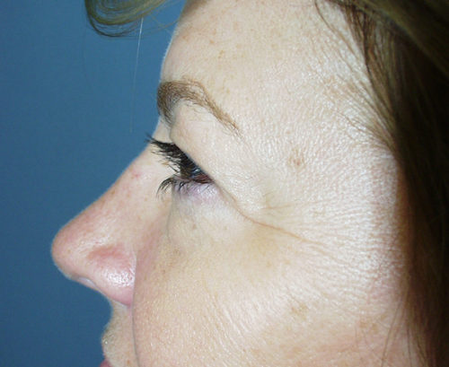 Eyelid Surgery Case 1172 Before Photo Eyelid Surgery