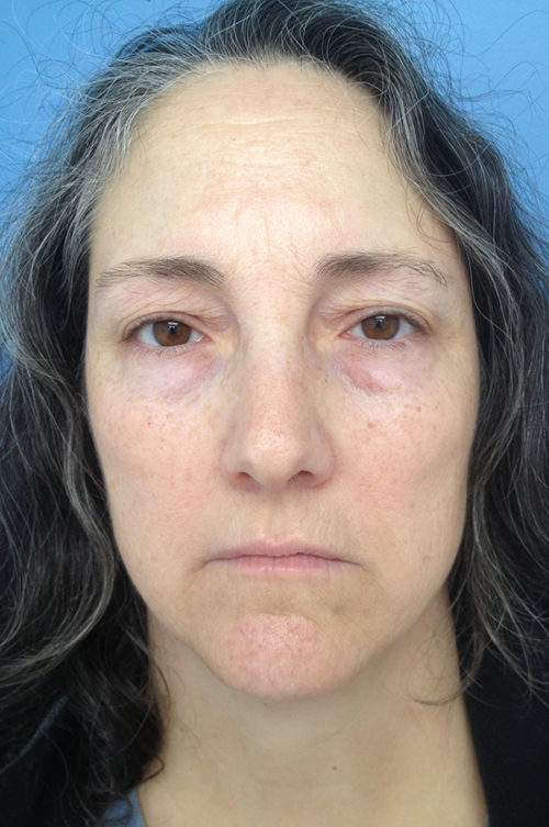 Eyelid Surgery