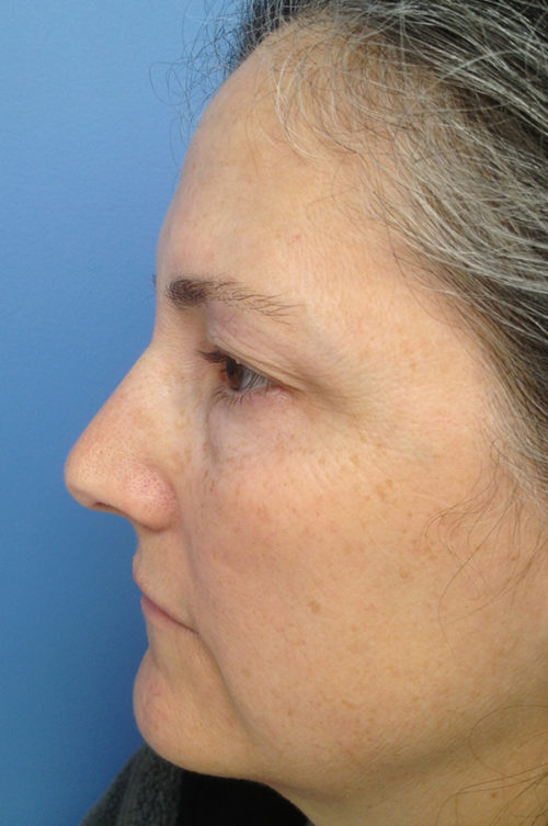 Eyelid Surgery