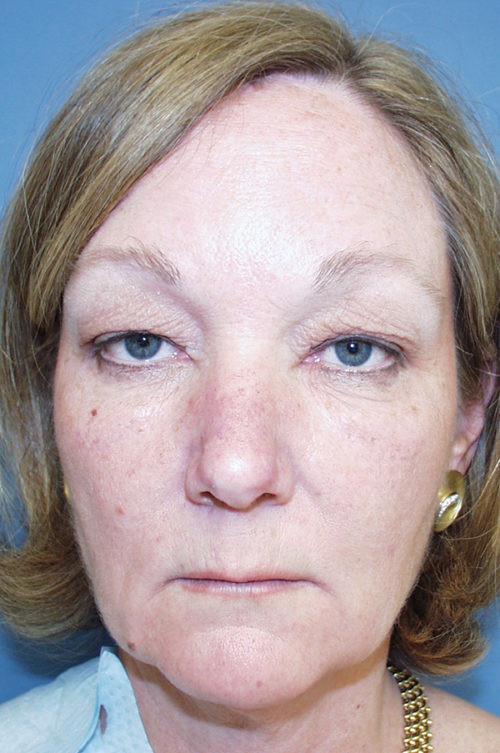 Eyelid Surgery