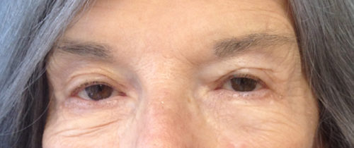 Eyelid Ptosis