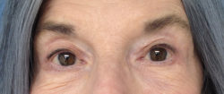 Eyelid Ptosis