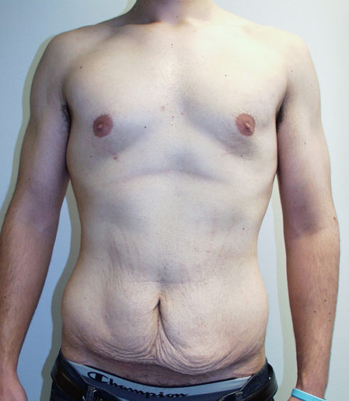 Male Abdominoplasty/Body Lift