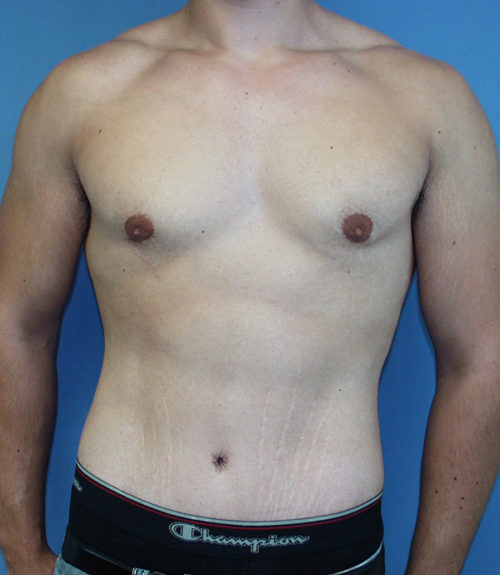 Male Abdominoplasty/Body Lift