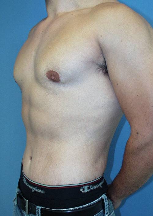 Male Abdominoplasty/Body Lift