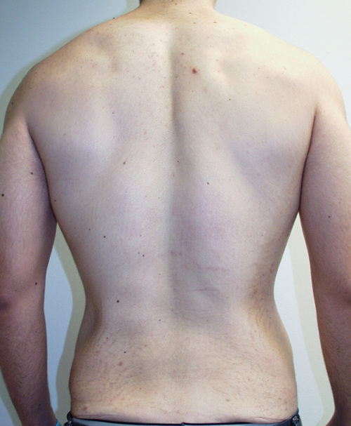 Male Abdominoplasty/Body Lift