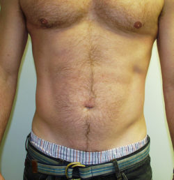 Abdominal Liposuction