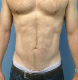 Abdominal Liposuction