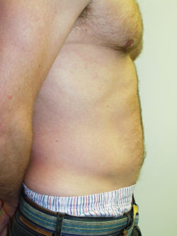 Abdominal Liposuction