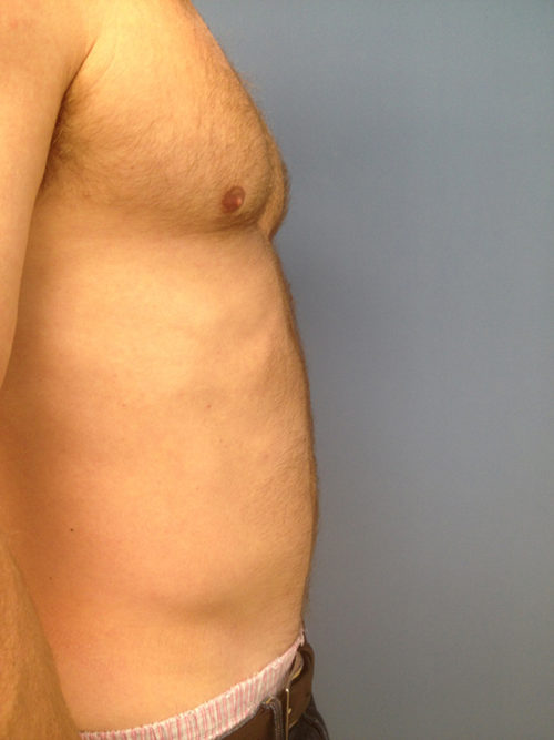 Abdominal Liposuction