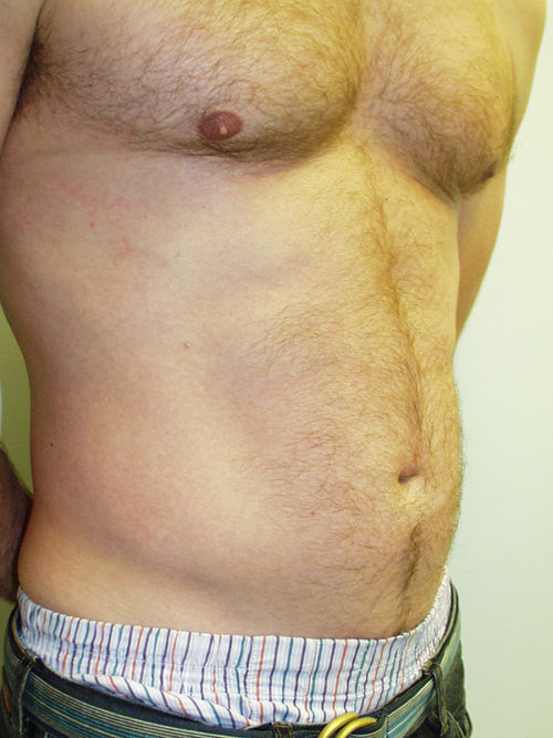 Abdominal Liposuction