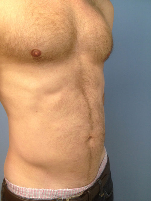 Abdominal Liposuction