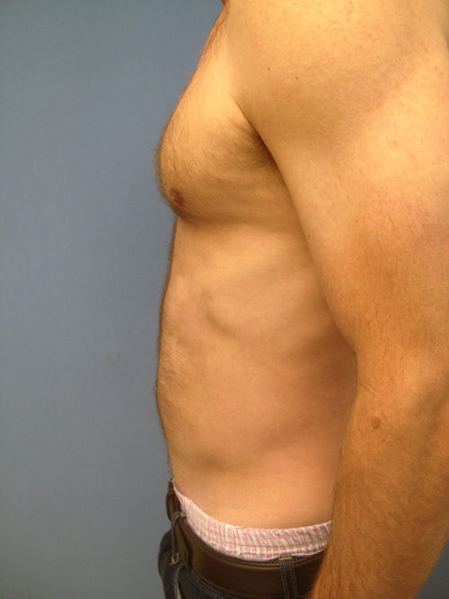 Abdominal Liposuction