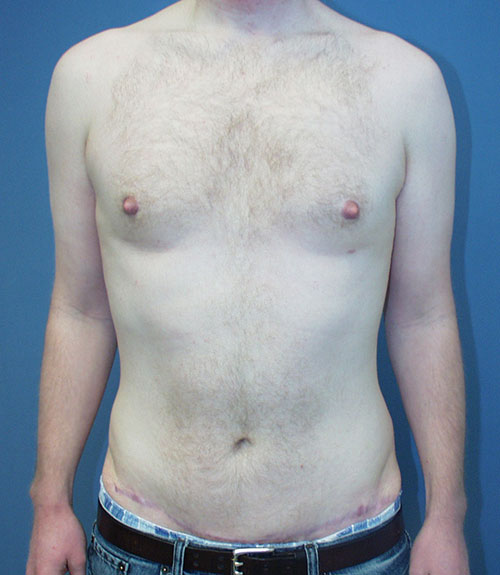 Male Breast Reduction