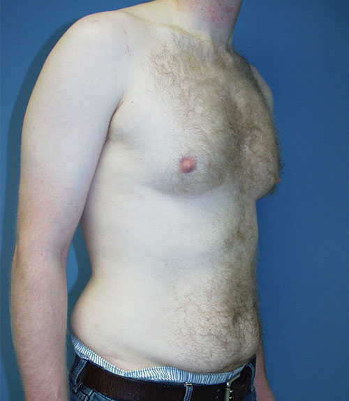 Male Breast Reduction