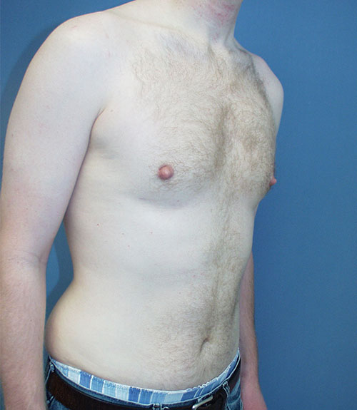 Male Breast Reduction