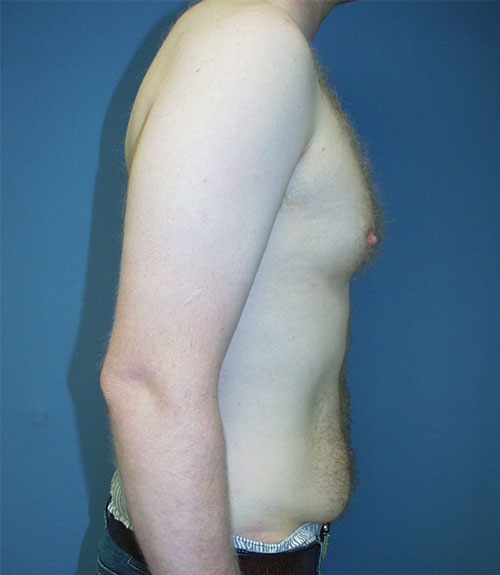 Male Breast Reduction