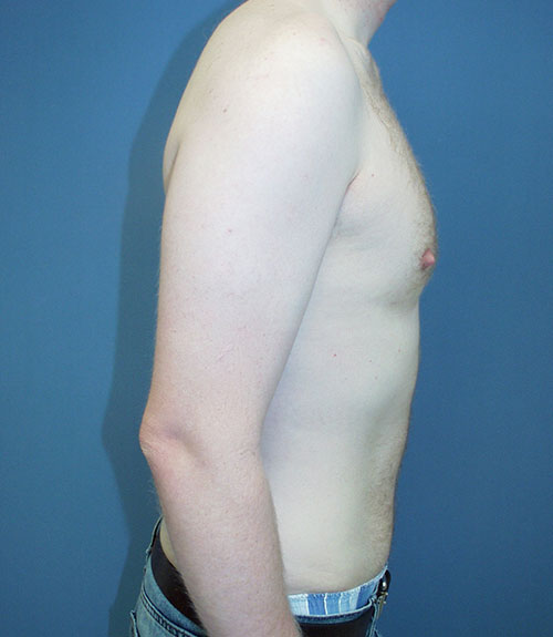 Male Breast Reduction Case 1253 After Photo Male Breast Reduction