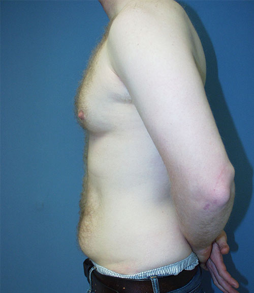 Male Breast Reduction