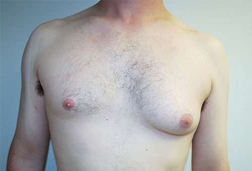 Male Breast Reduction