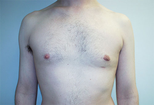 Male Breast Reduction