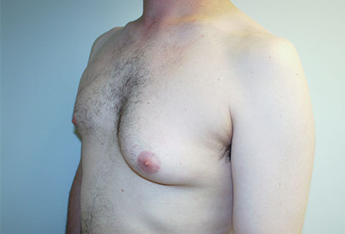 Male Breast Reduction