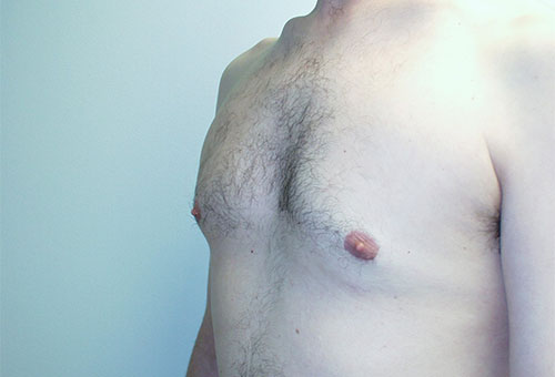 Male Breast Reduction