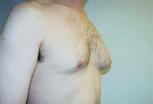 Male Breast Reduction