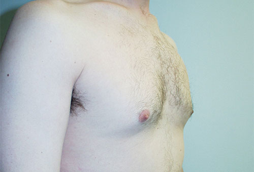 Male Breast Reduction