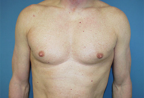 Male Breast Reduction