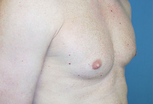 Male Breast Reduction