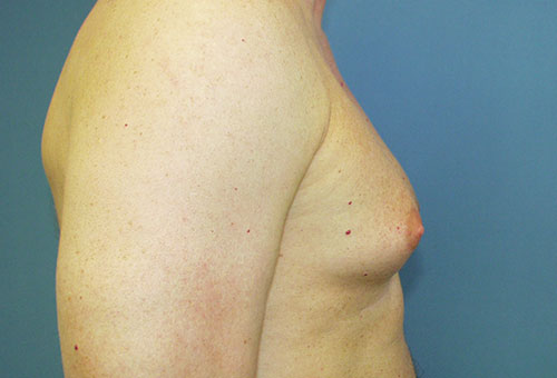 Male Breast Reduction