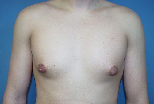 Male Breast Reduction Case 1289 Before Photo Male Breast Reduction