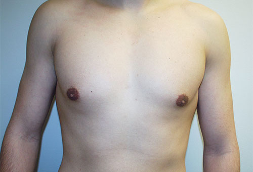 Male Breast Reduction Case 1289 After Photo Male Breast Reduction