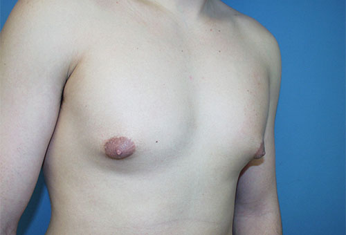 Male Breast Reduction Case 1289 Before Photo Male Breast Reduction