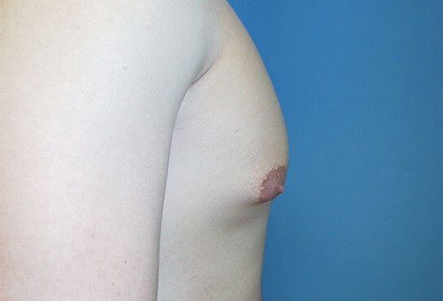 Male Breast Reduction Case 1289 Before Photo Male Breast Reduction