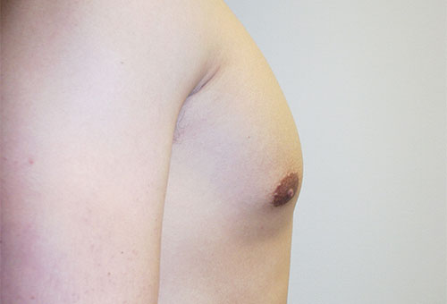 Male Breast Reduction Case 1289 After Photo Male Breast Reduction