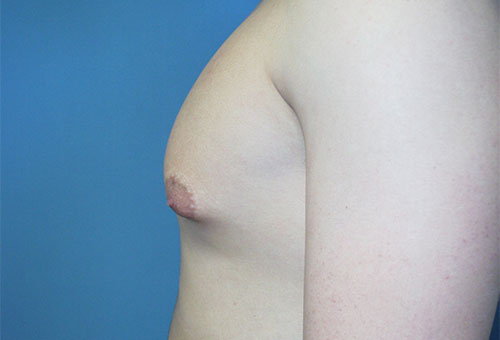 Male Breast Reduction Case 1289 Before Photo Male Breast Reduction