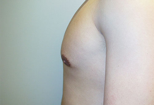 Male Breast Reduction Case 1289 After Photo Male Breast Reduction