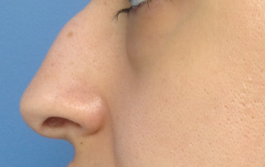 Rhinoplasty Results Washington DC
