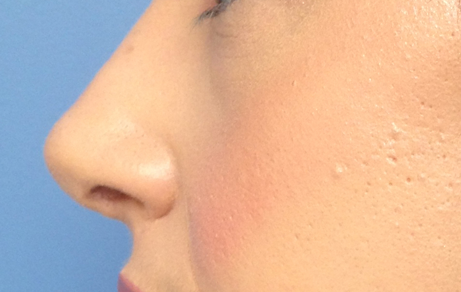 Rhinoplasty Results Washington DC